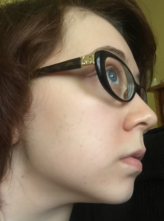 5710024c59ab2_AcneRight2.thumb.png.f36d1