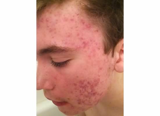 Zack acne part 2-1.jpg