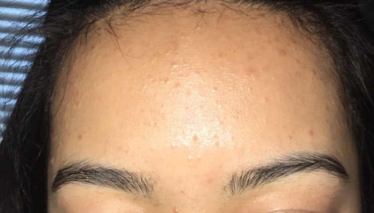 FOREHEAD ACNE PLS HELP PLS - General acne discussion - by cado - Acne ...