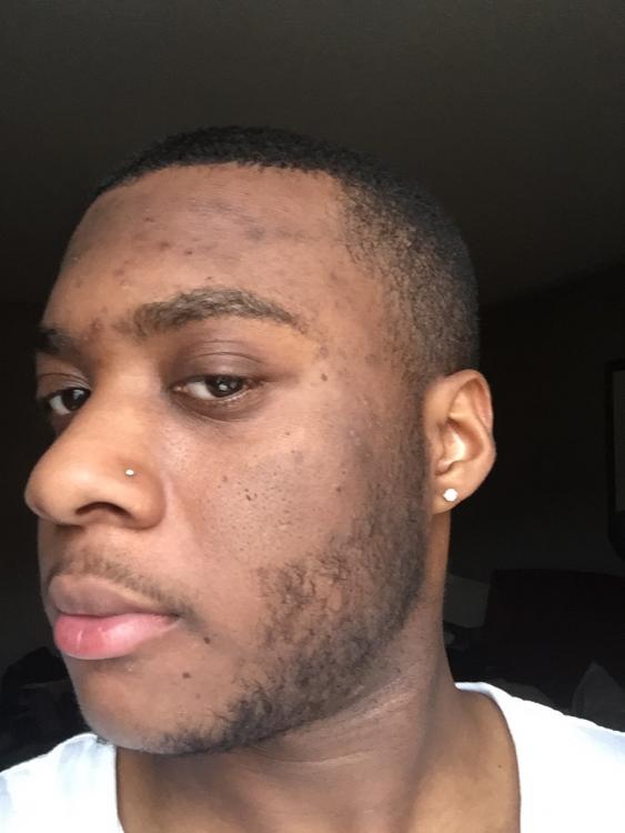 *photos* uneven skin tone, how do i fix? african american 