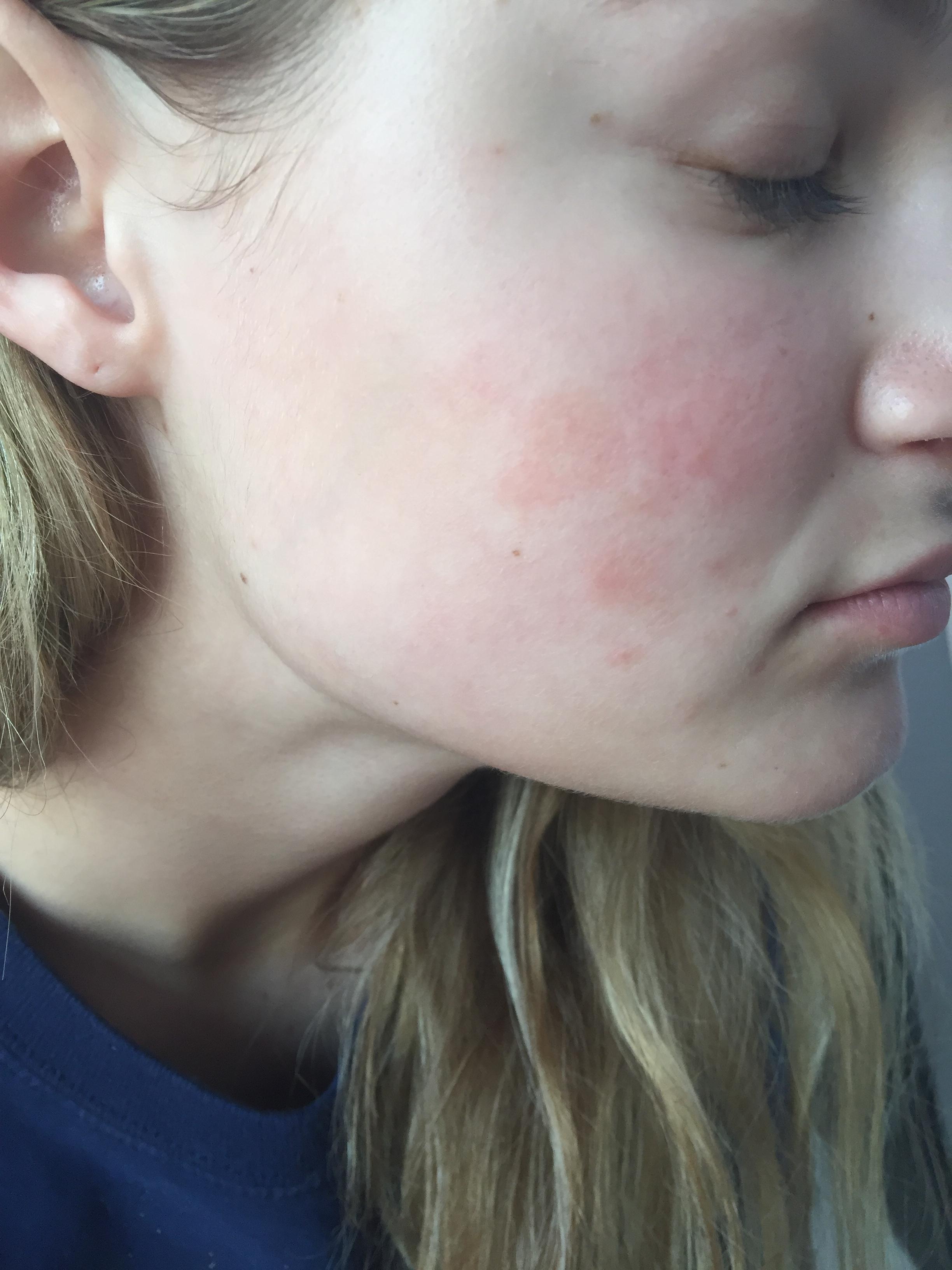 Random Red Patches On Face Rosacea And Facial Redness By