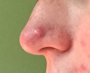 tip of nose sore to touch