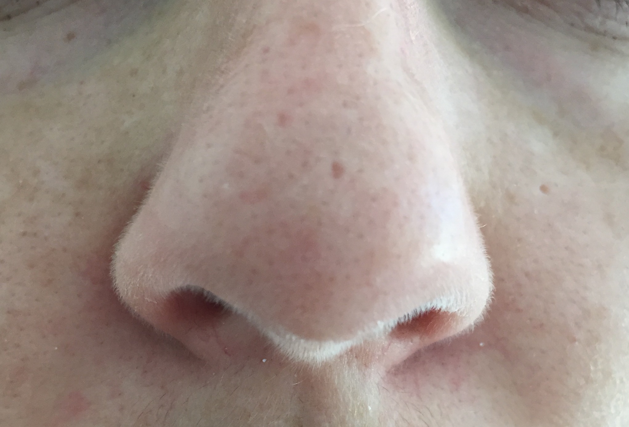 needling-on-tip-of-nose-scar-treatments-acne-forum