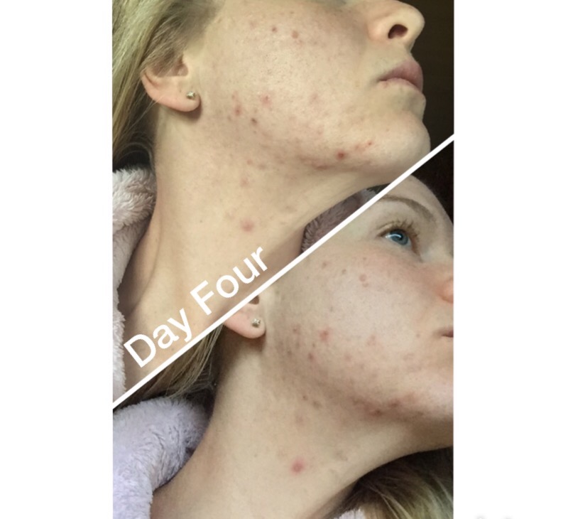 doxycycline hyclate for acne reviews