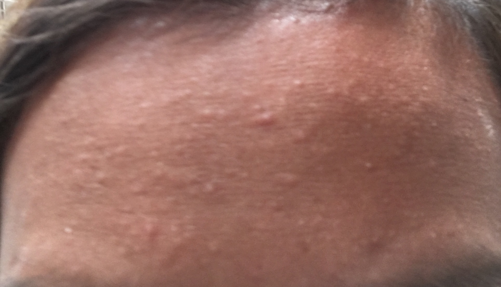 red-bumps-on-face