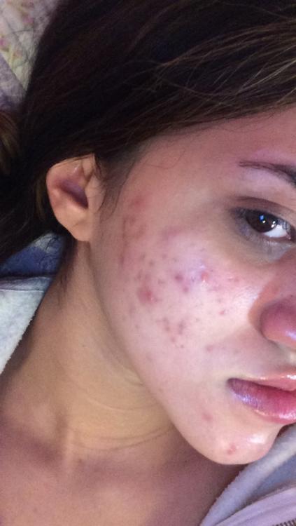 help-getting-rid-of-red-purple-marks-scar-treatments-acne-forum