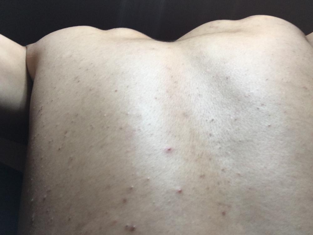 Chronic body acne - Back/Body/Neck acne - by Jmakk - Acne ...