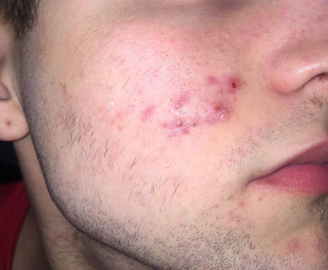 connor-s-pimples-hyperpigmentation-scars-that-won-t-go-away