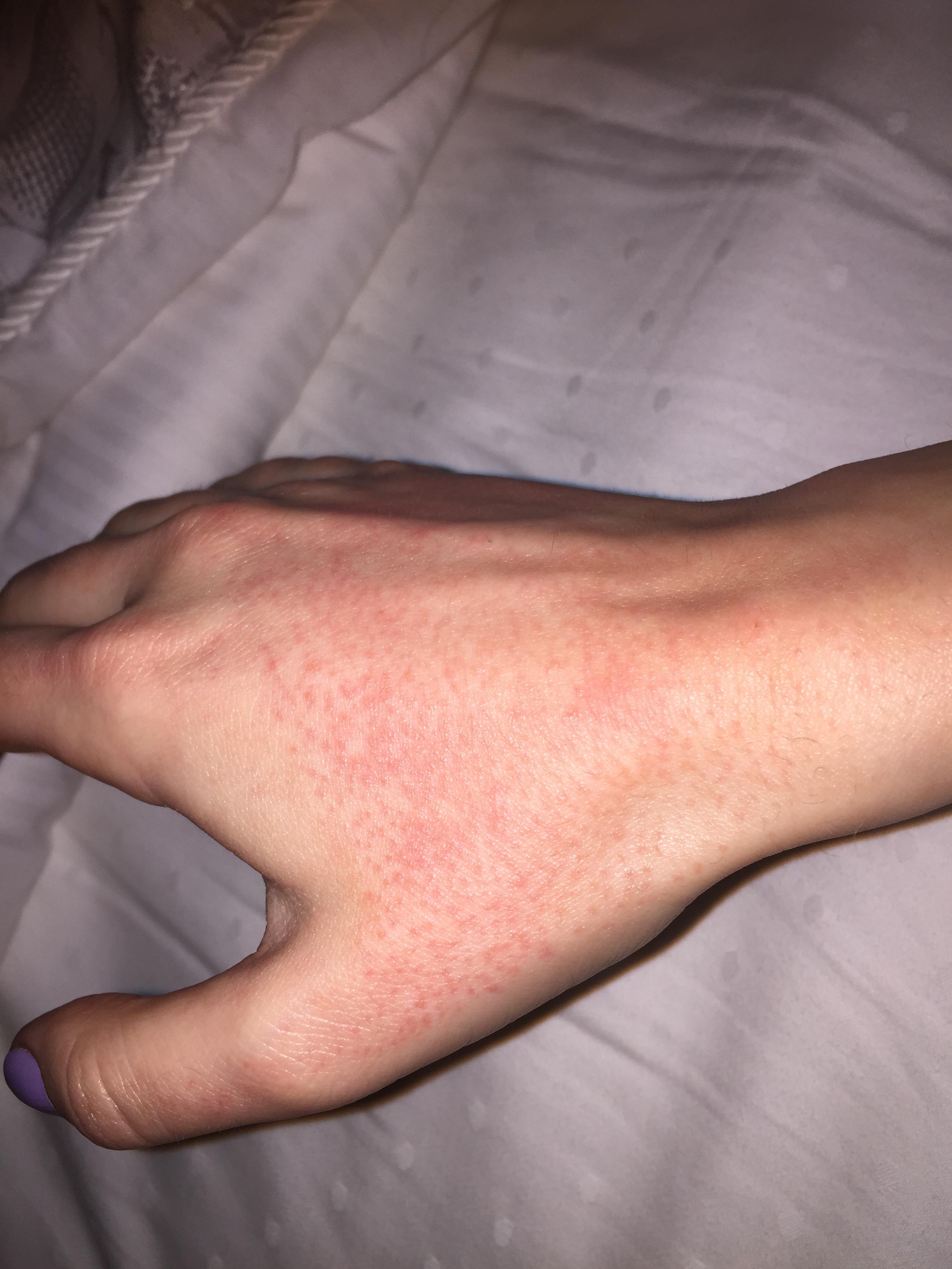 HELP! Rash on hands from Accutane? Prescription acne