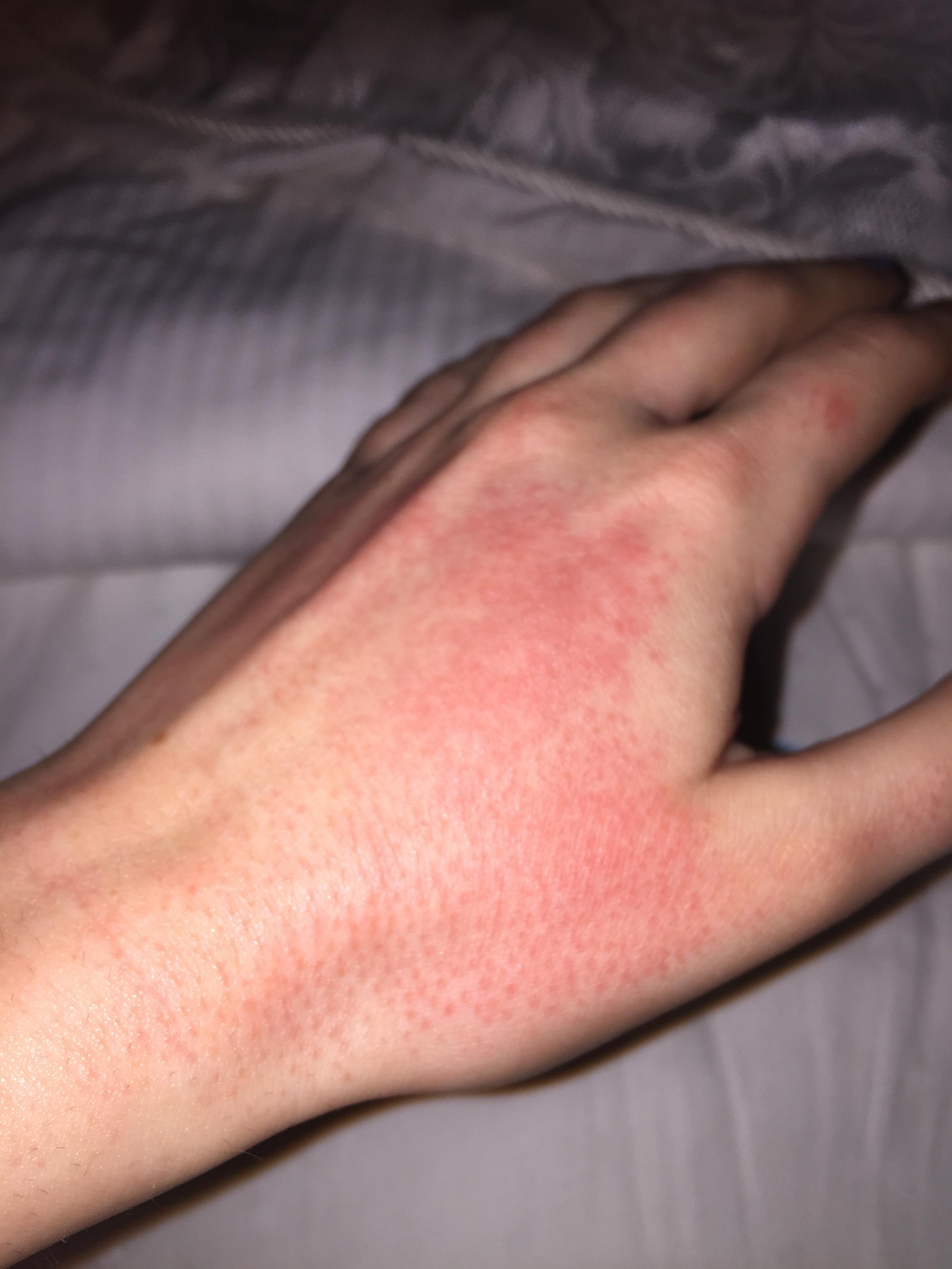 Skin Rashes On Hands Treatment