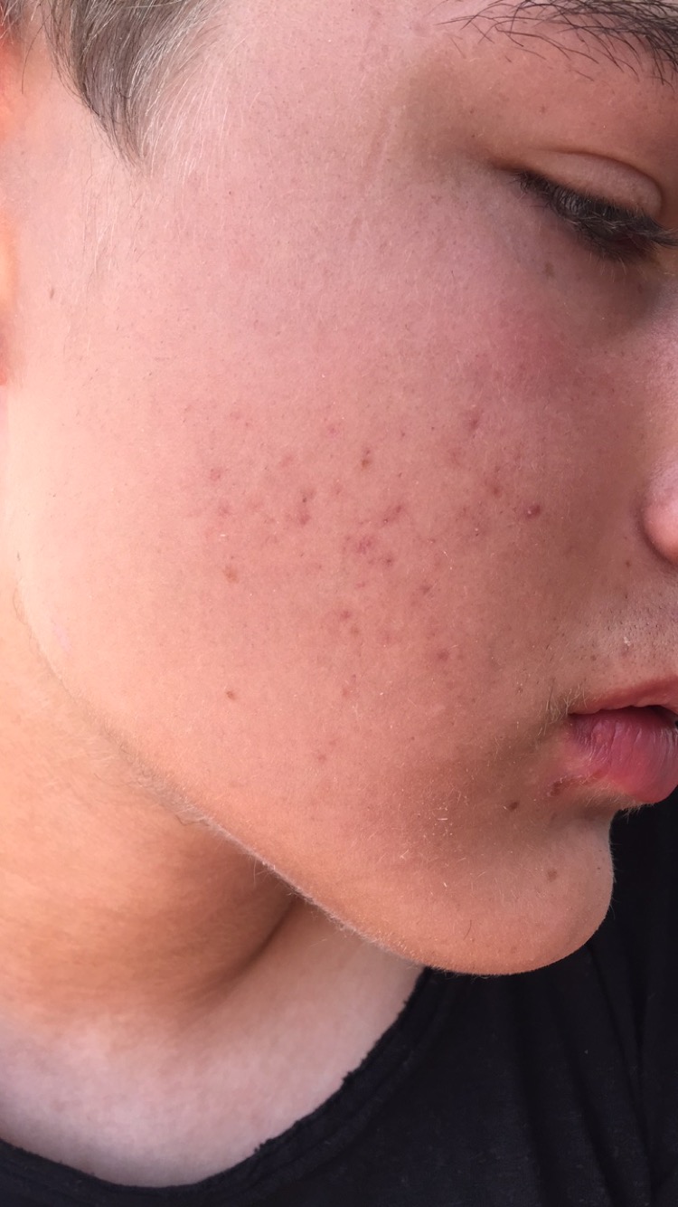 red-marks-ruining-my-life-please-help-hyperpigmentation-red-dark