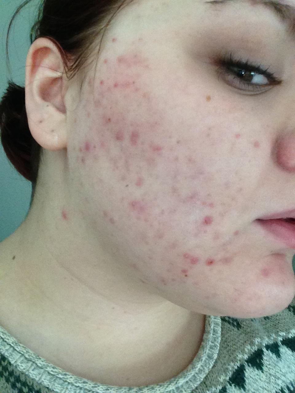 Sudden Adult Acne Pcos Hormonal Acne Acne