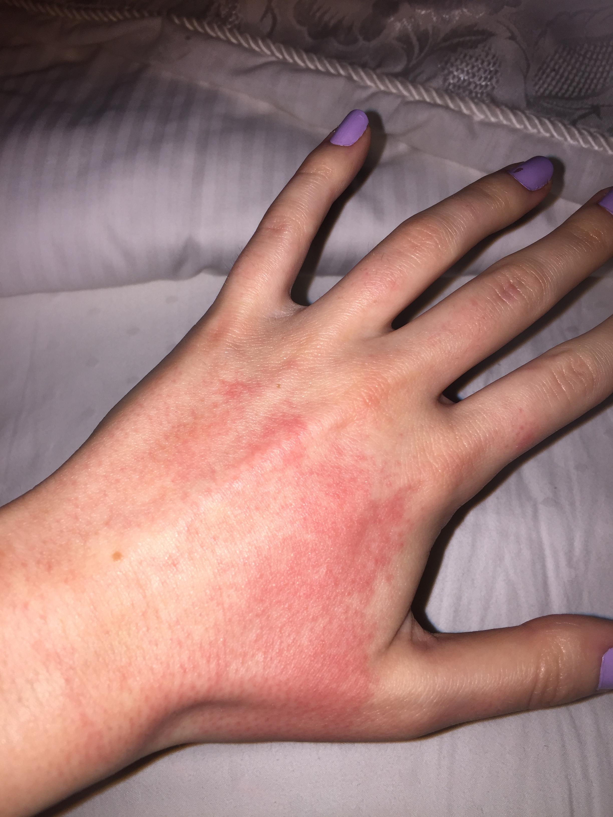 Why do my hands have a rash