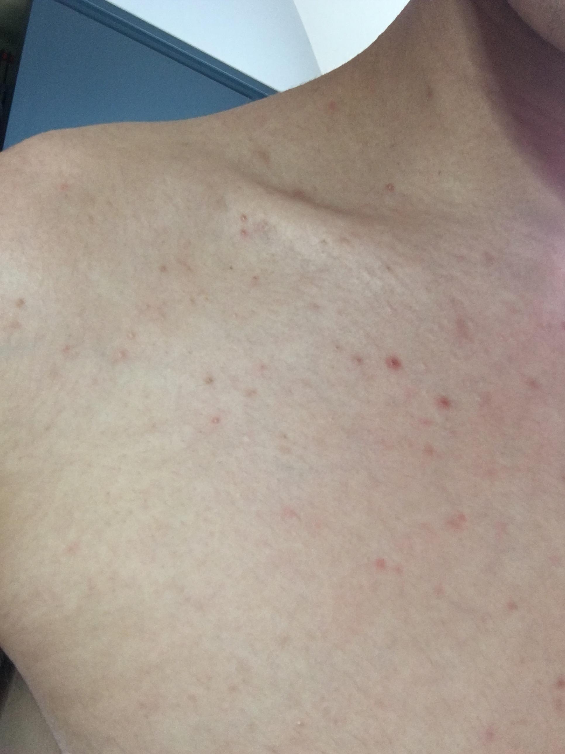 Small bumps all over chest – Back/Body/Neck acne –  Forum