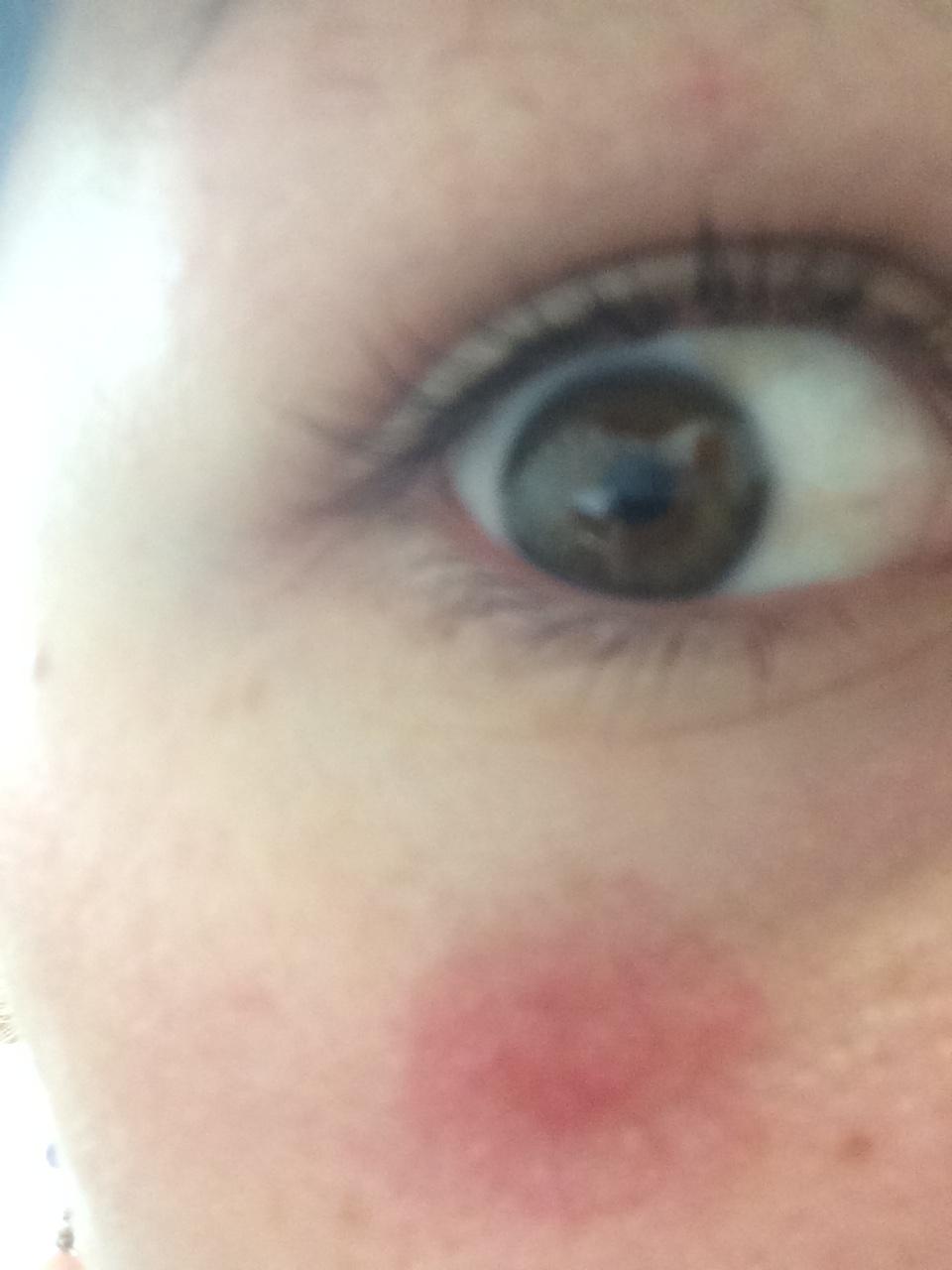 red-dark-circle-spot-underneath-eye-rosacea-facial-redness-acne