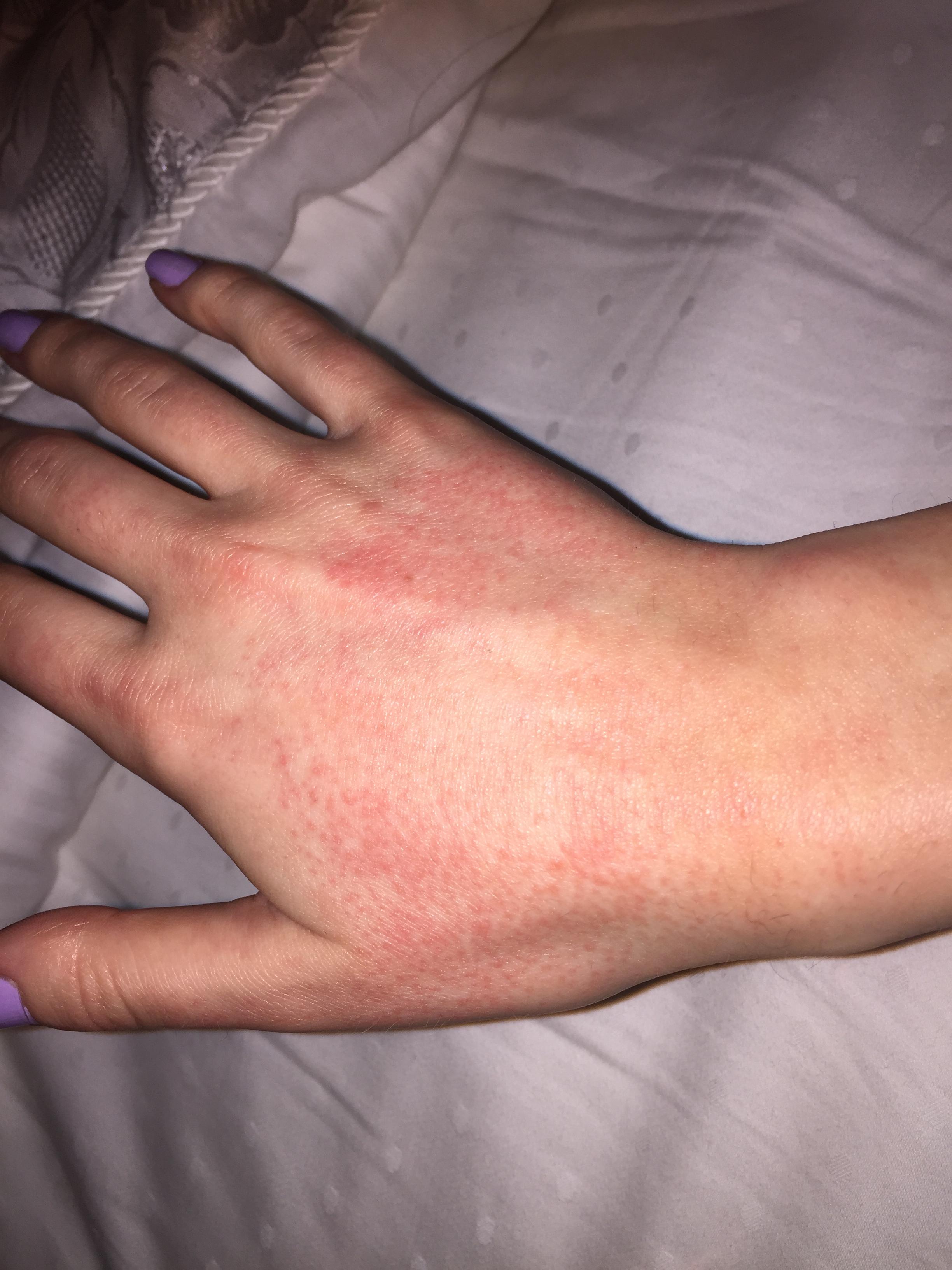 Help Rash On Hands From Accutane Prescription Acne Medications Forum 