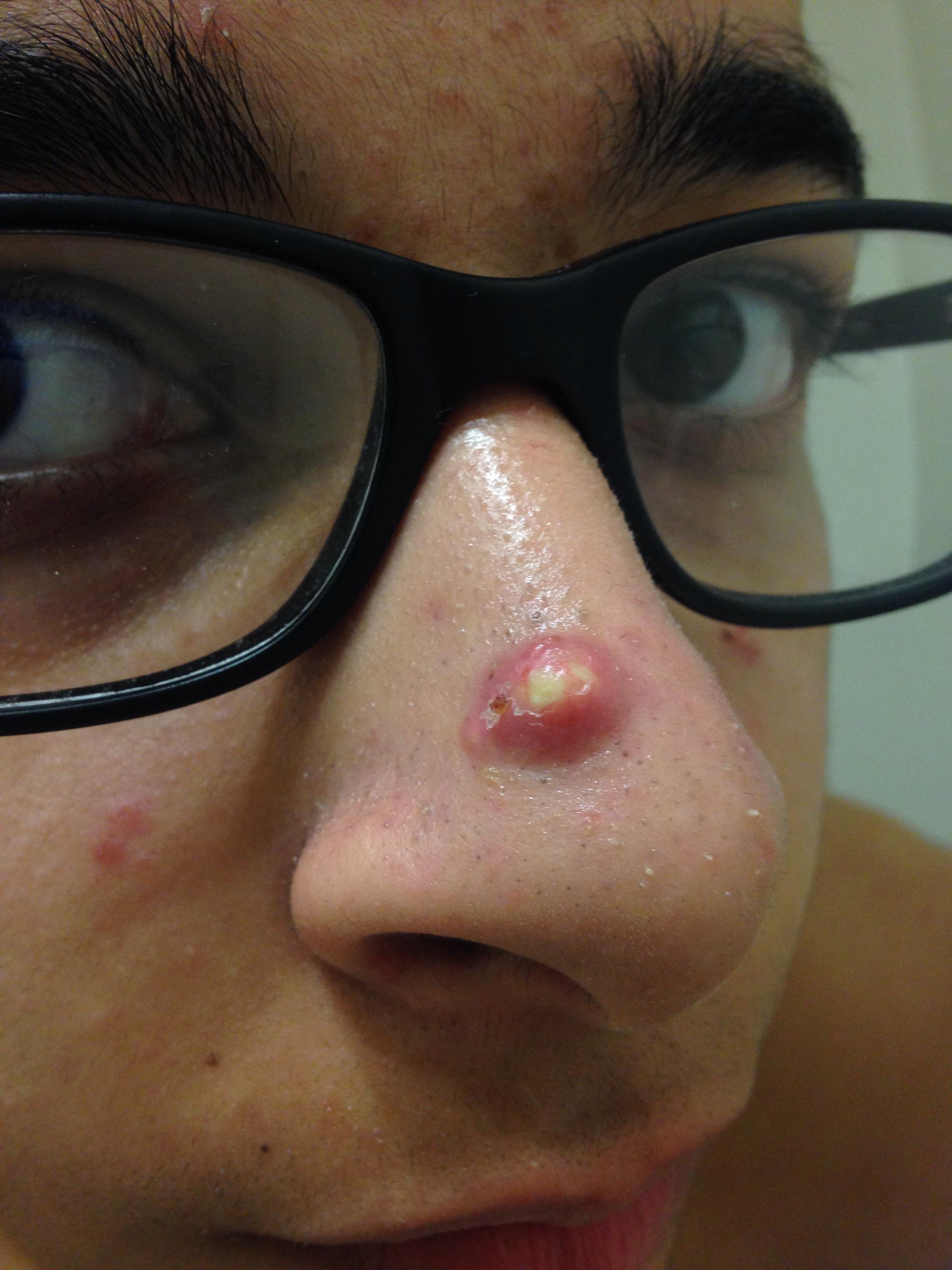 pimple under nose
