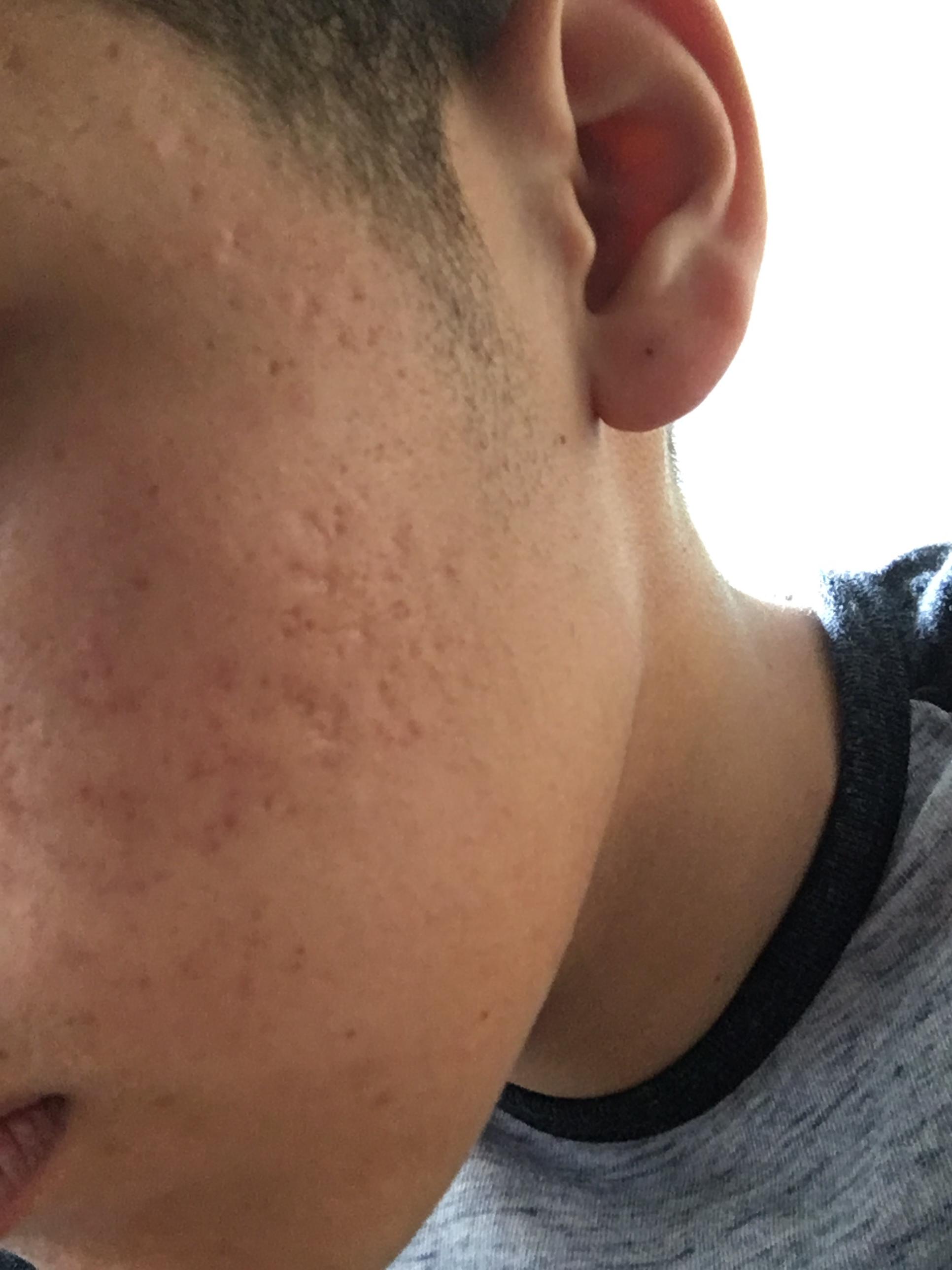 What Type Of Acne Scars Do I Have And What S The Best Treatment In Your