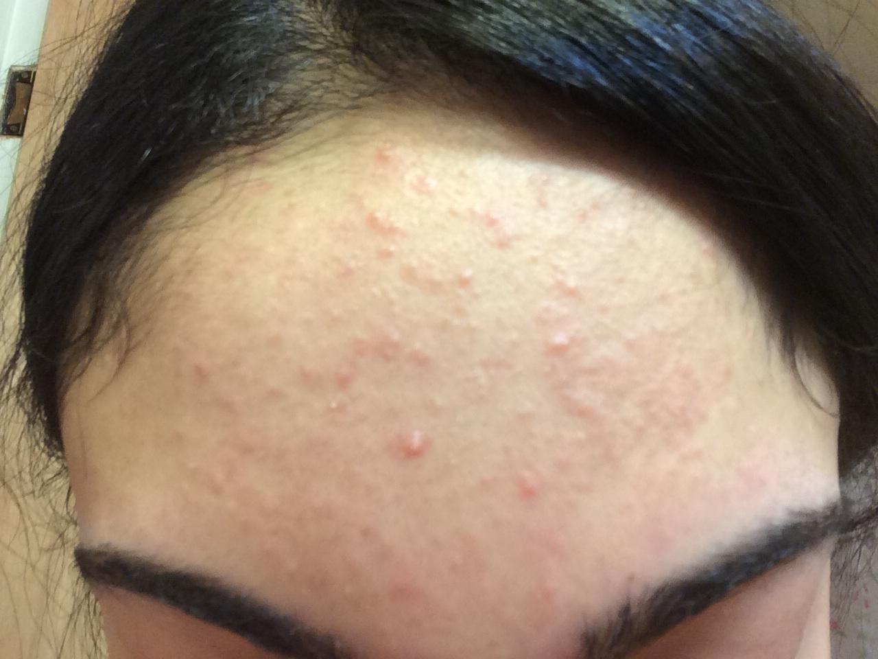 papules-on-forehead