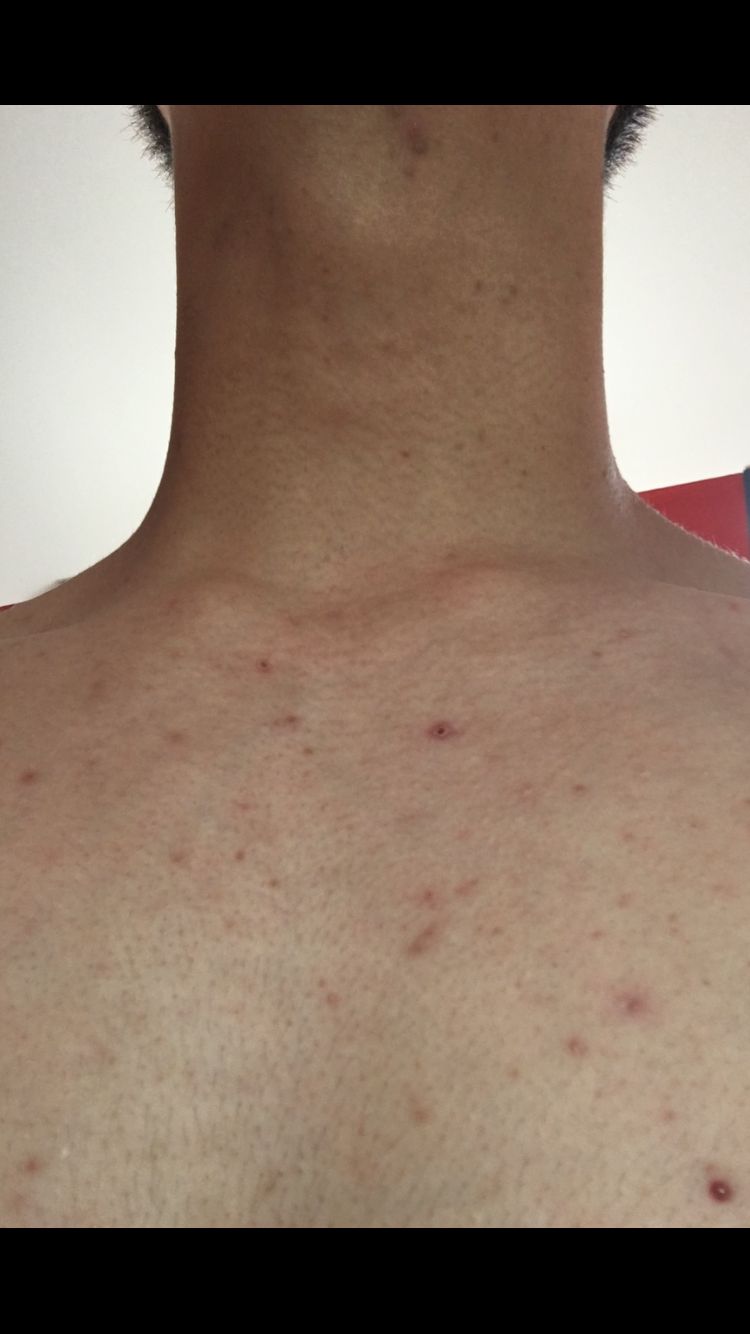 Acne Between My Inner Thighs – Back/Body/Neck acne –  Forum