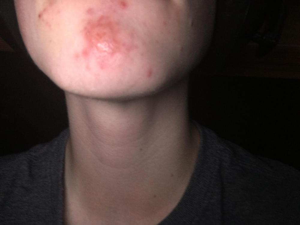 i-have-a-big-red-pimple-on-my-chin-general-acne-discussion-acne