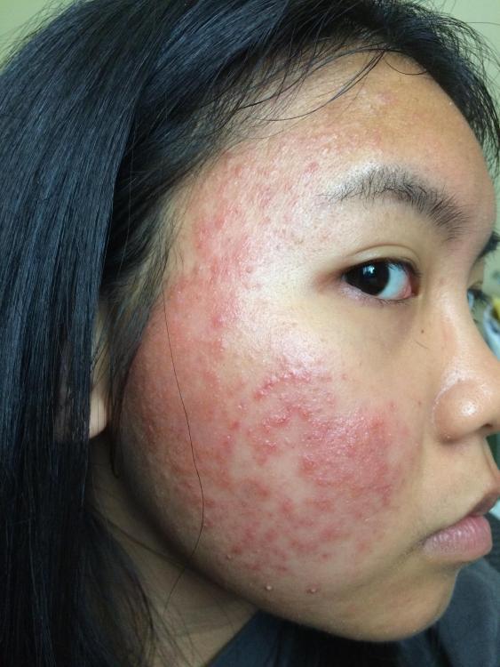 Allergic reaction to acne.org regimen ? - Acne.org products - by Han
