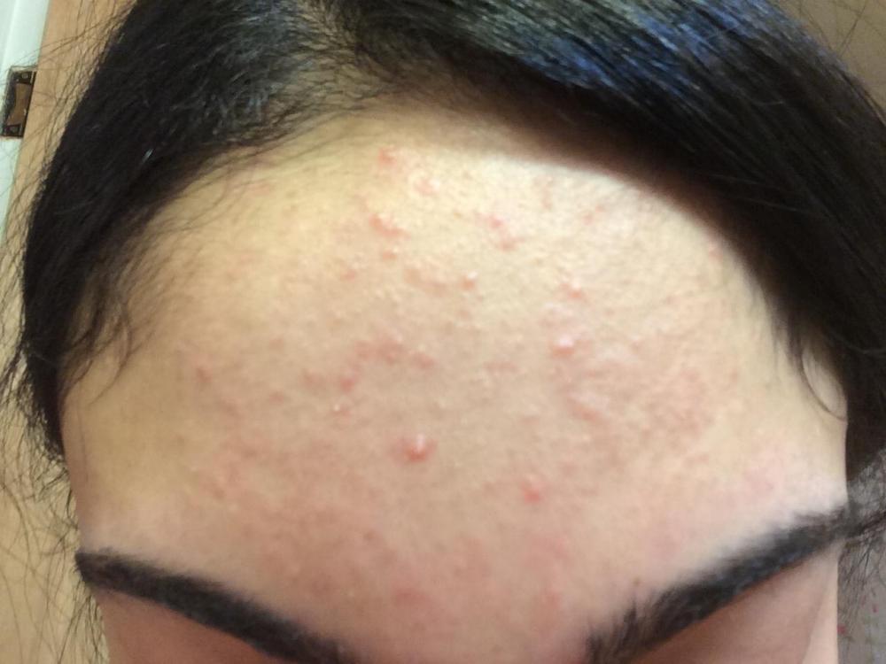 bumps-on-skin-that-look-like-pimples