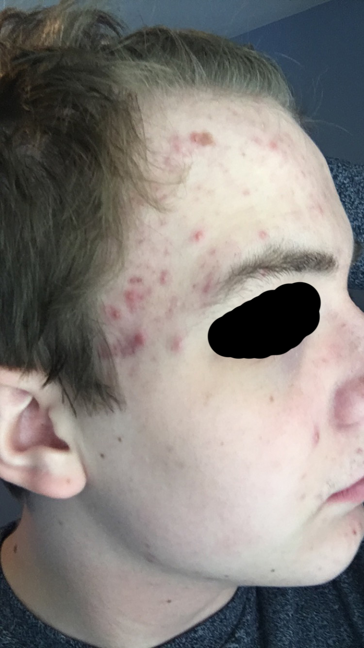 How Bad Is My Acne Pics General Acne Discussion 