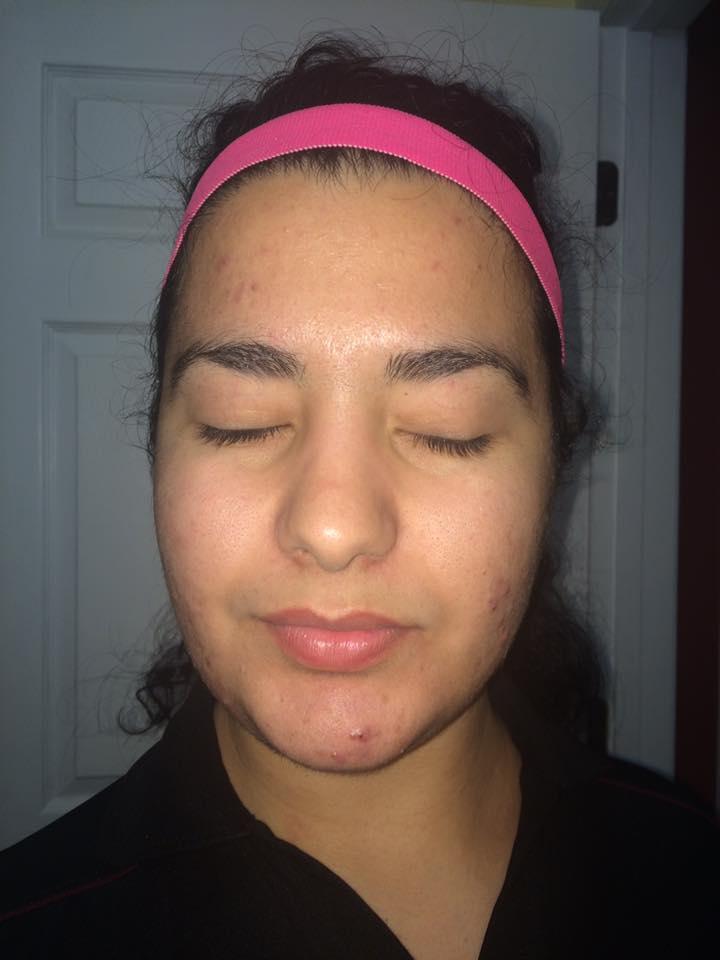 My acne journey