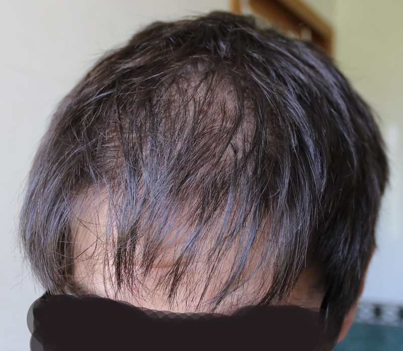 Long term DIFFUSE hair loss after Accutane and sebum ...