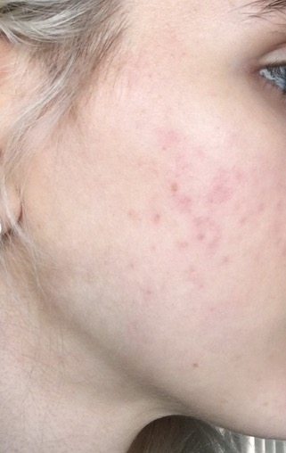 and together accutane doxycycline