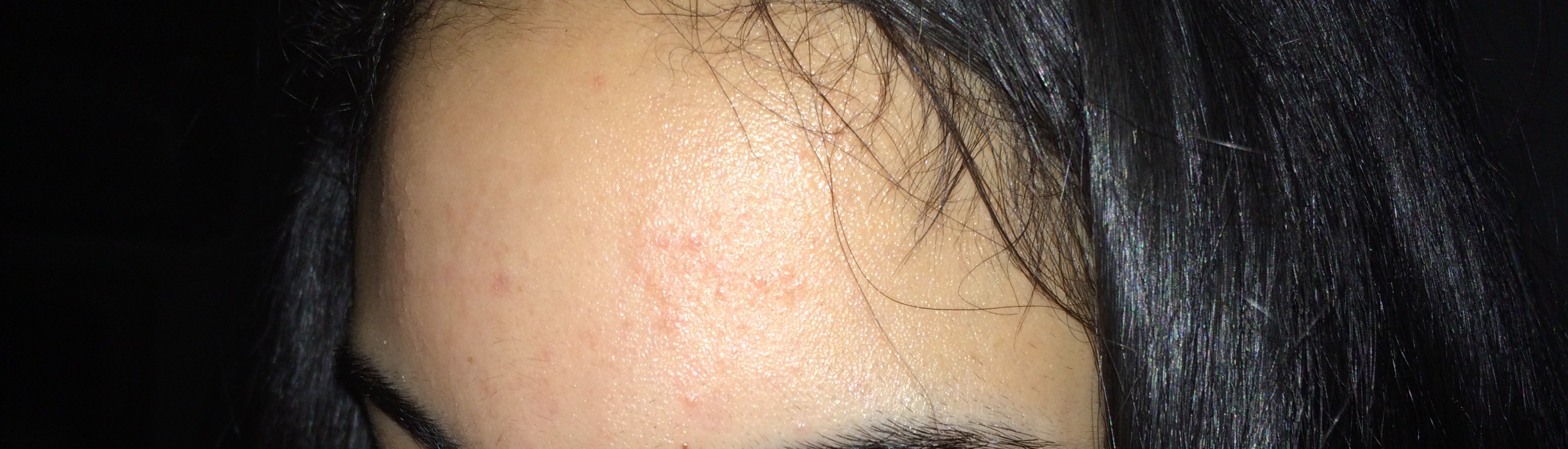 What Is This Patch Of Bumps On My Forehead Hypertrophic Raised