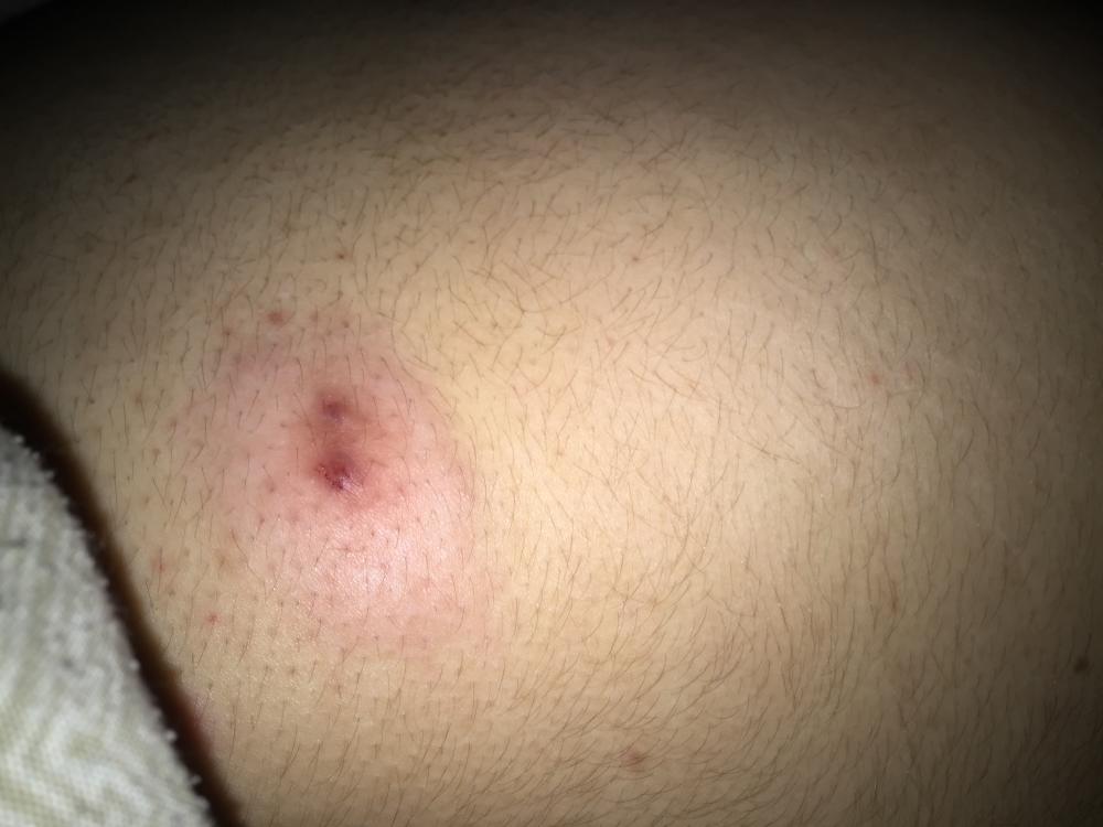 Huge zit On Upper Butt Cheeck Back Body Neck Acne Acne Forum