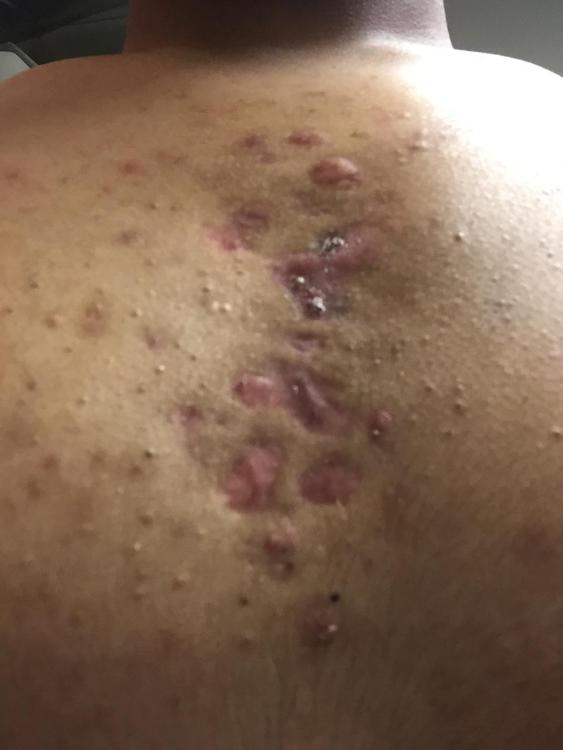 Is there any hope? Chest acne curse (pics) - Back/Body/Neck acne - Acne.org