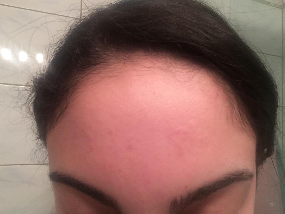 What Is This Patch Of Bumps On My Forehead Hypertrophic Raised Scars Acne Org Forum