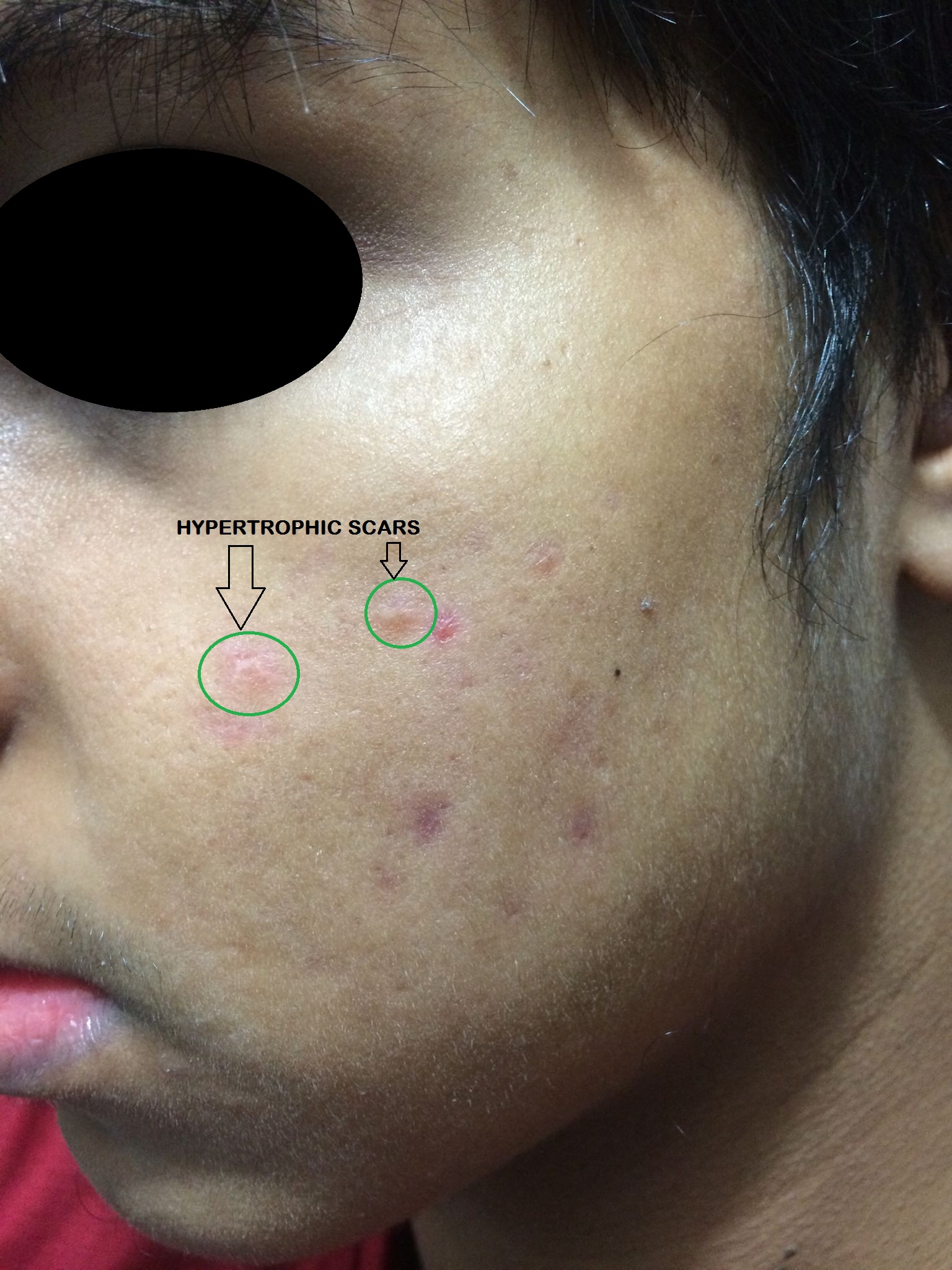 Hypertrophic Acne Scar