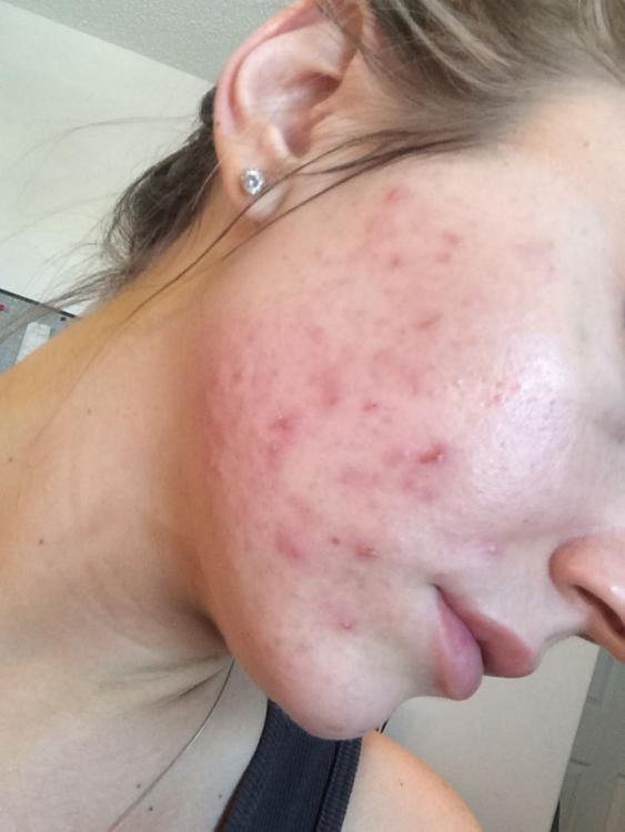 acne 3.jpg