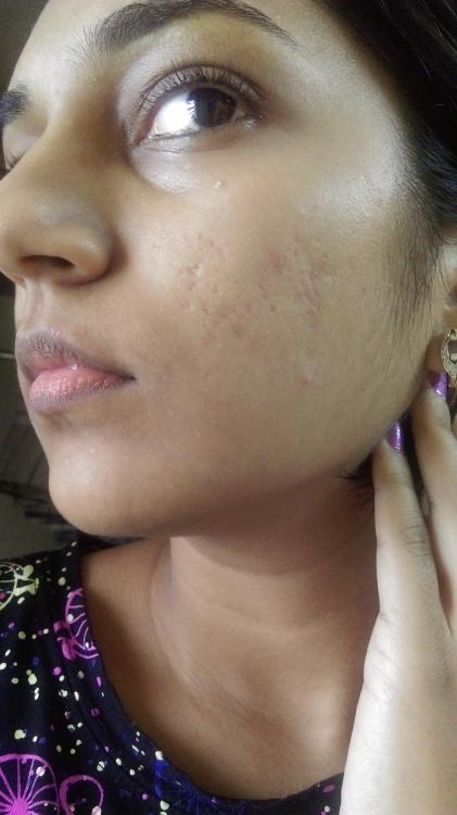 will-retin-a-work-on-these-scars-scar-treatments-acne-forum