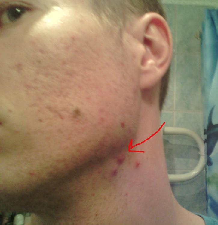 Does masturbation help acne