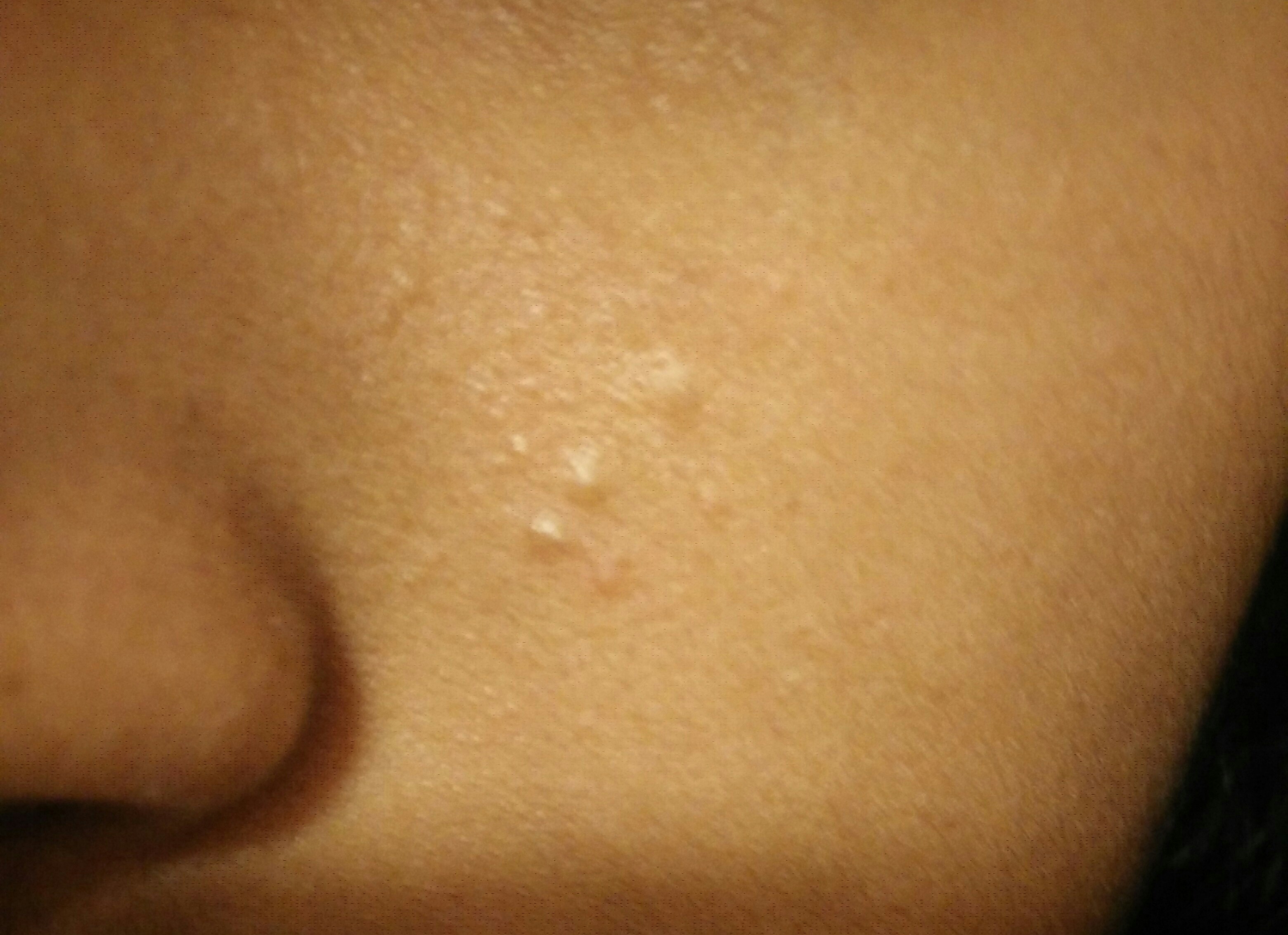 Small Bumps That Arent Pimples On Face General Acne Discussion