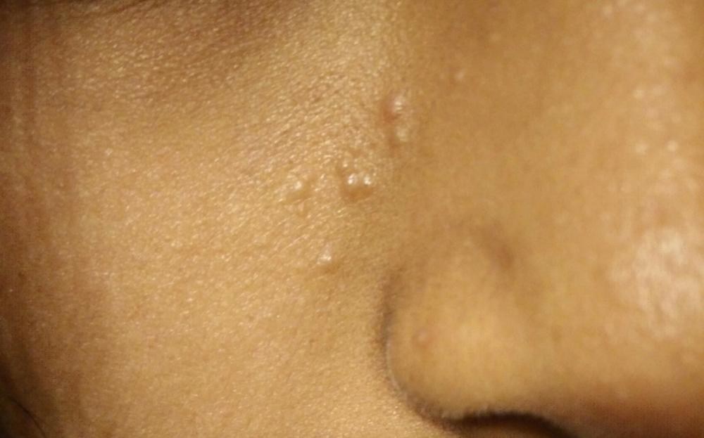 What Do Bumps On The Face Mean