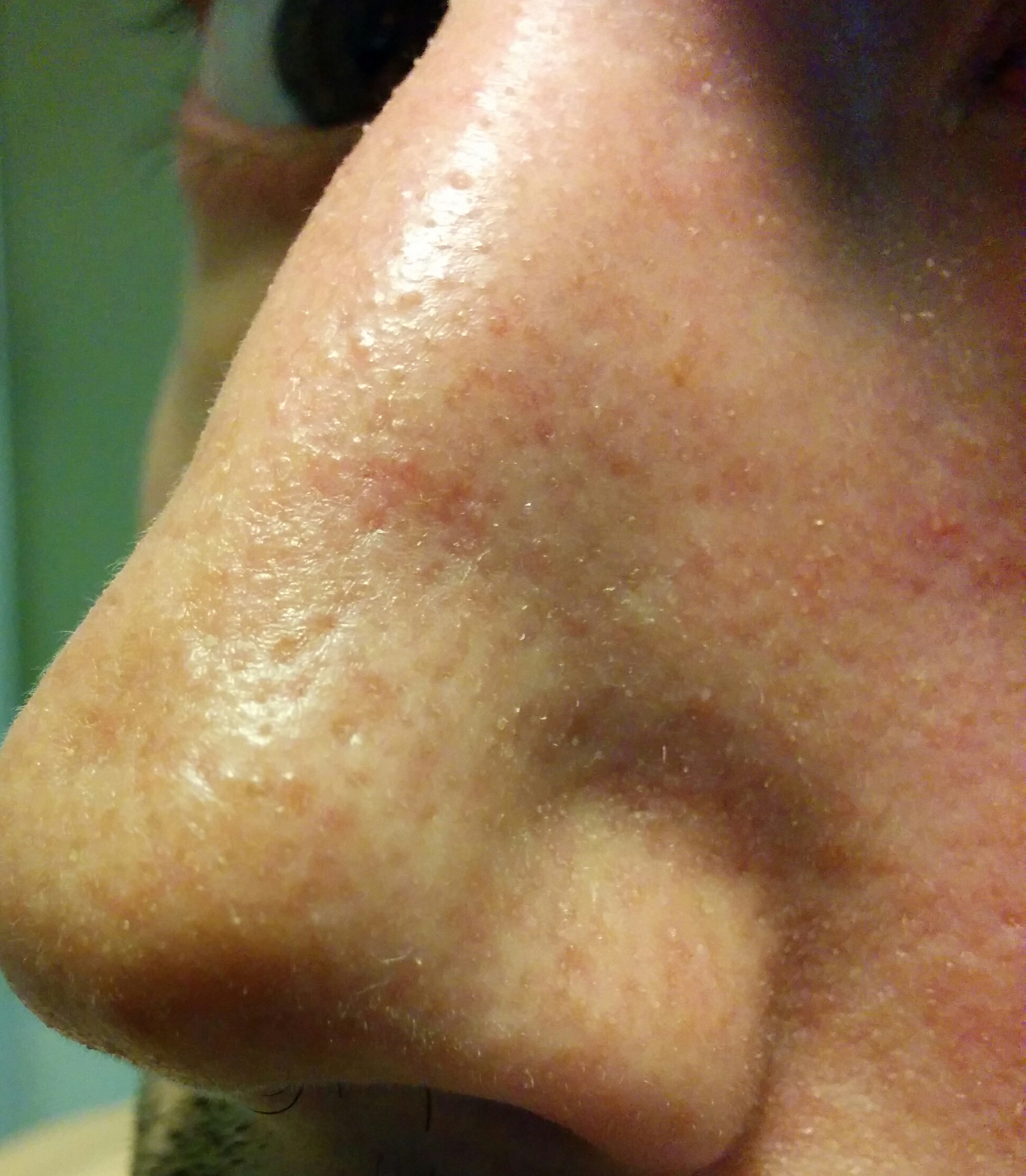 clogged pores bumps