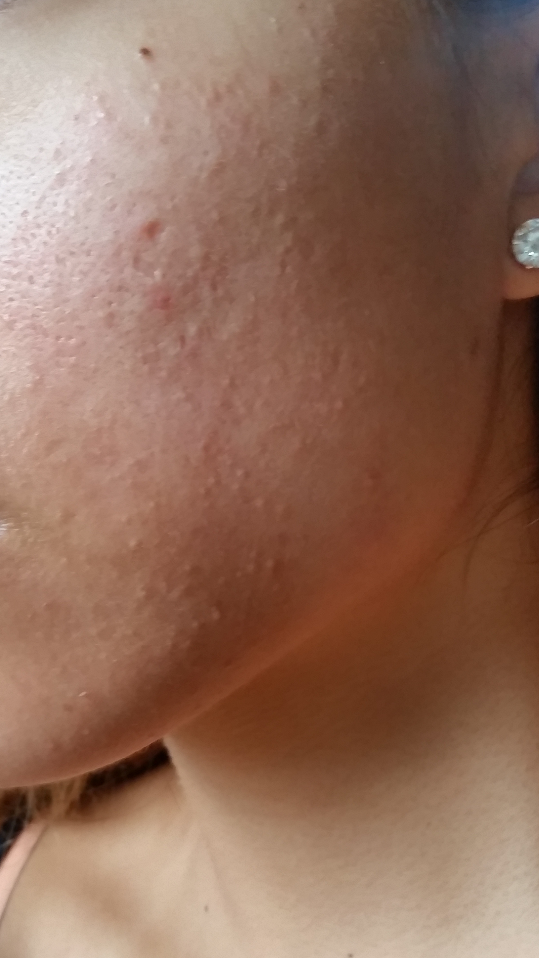Small bumps on face.
