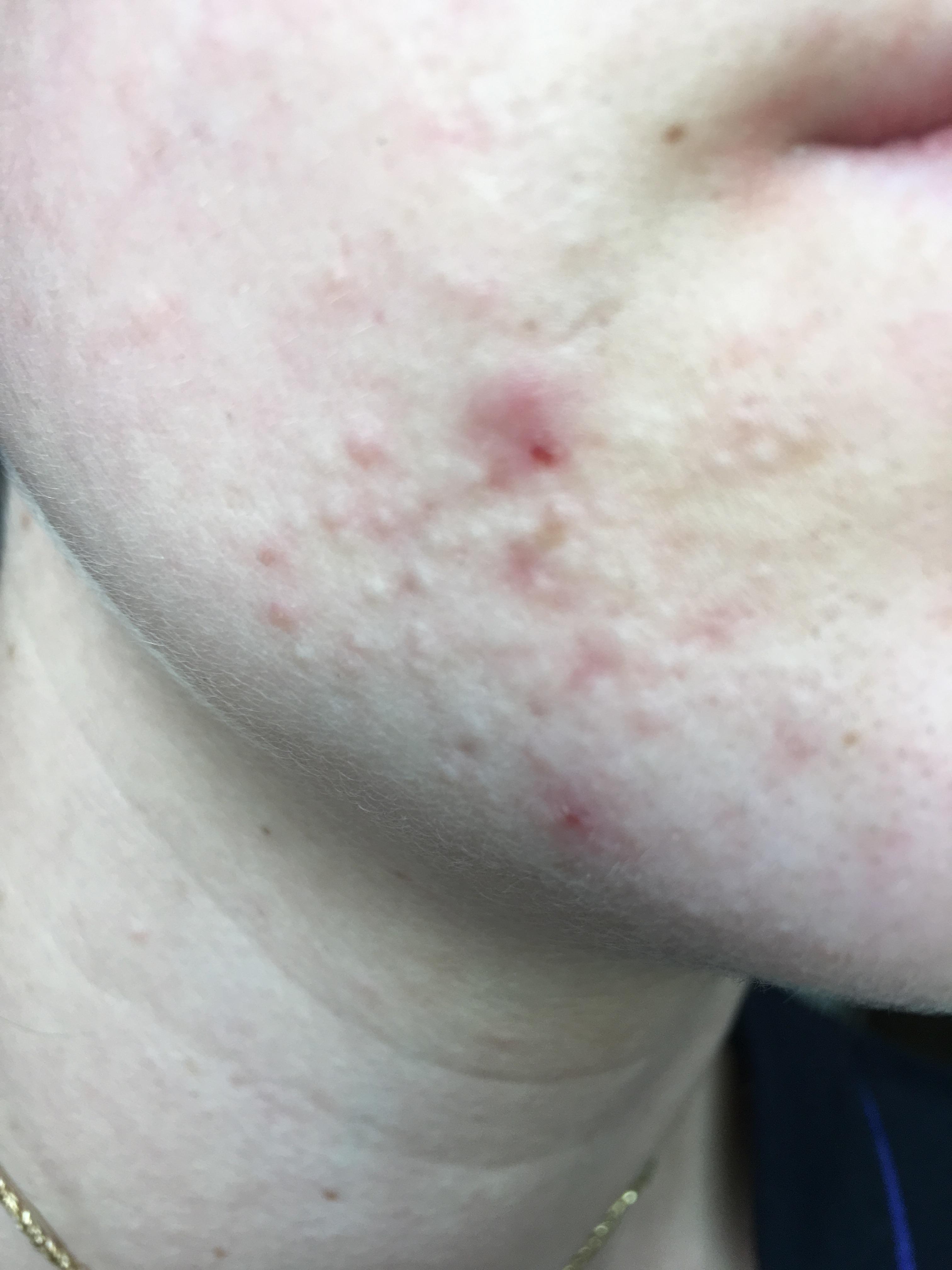 Small Flesh Colored Bumps on Forehead and Hairline - Adult acne - by