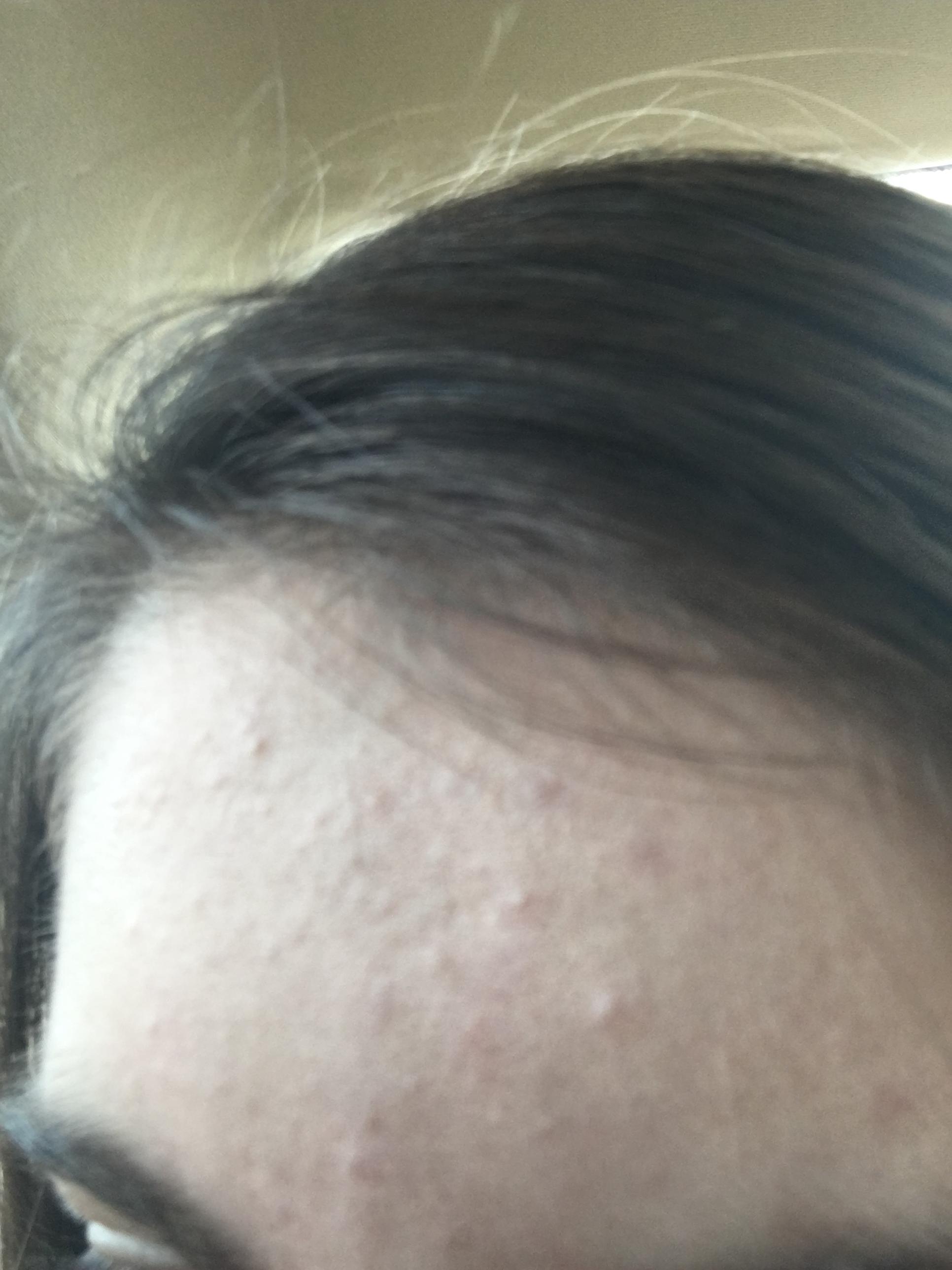 Bumps And Acne Only On The Forehead General Acne Discussion Forum 1384