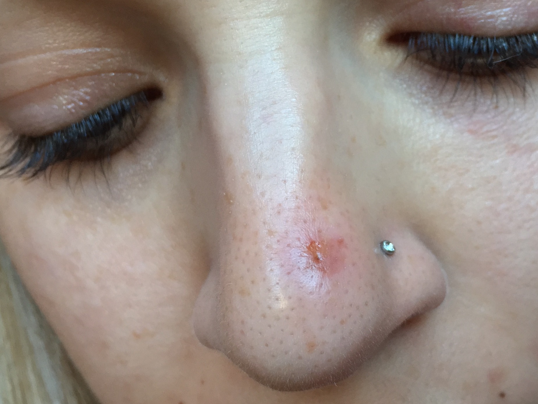 Big Pimple On Nose