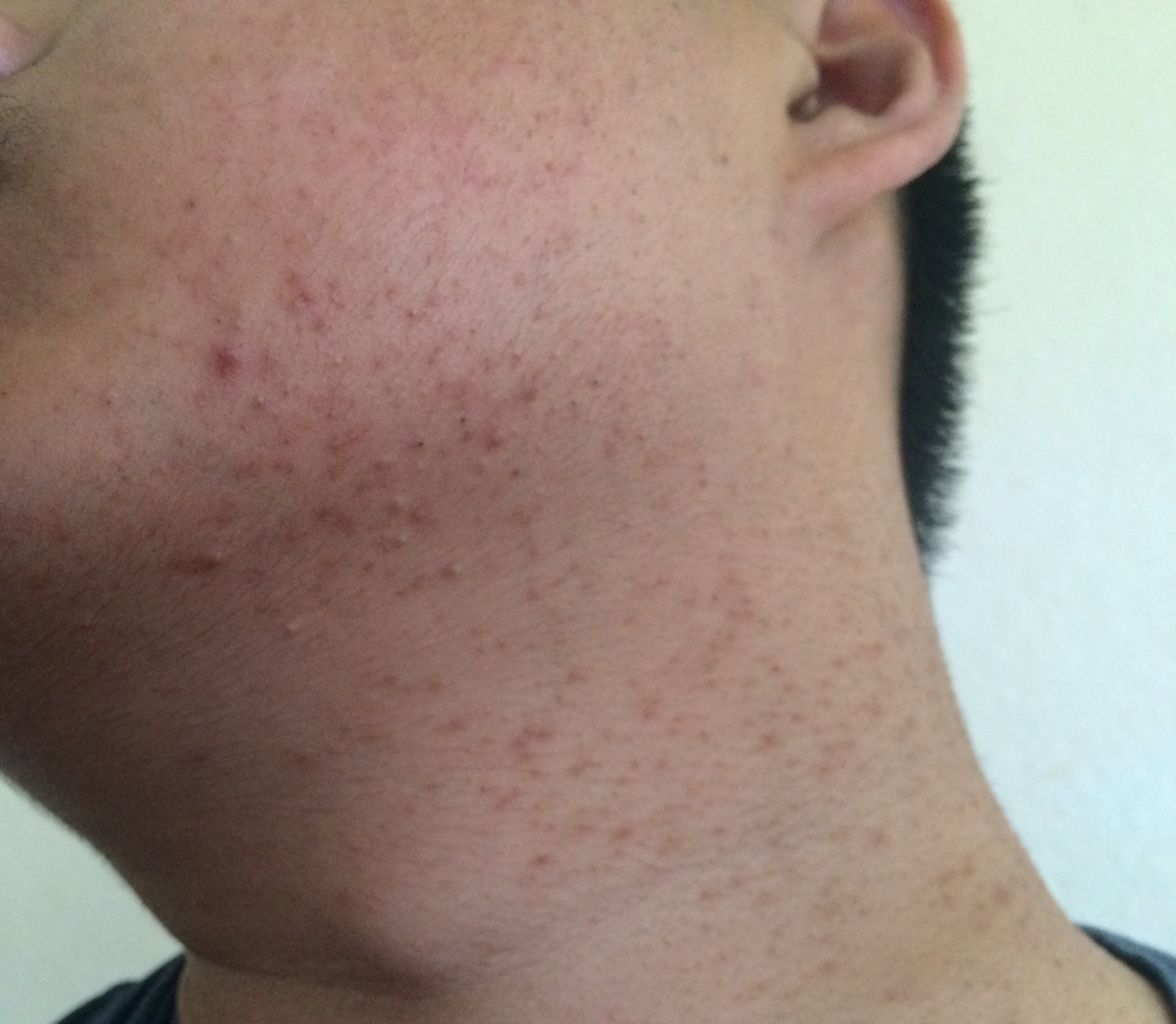 Malassezia Folliculitis General Acne Discussion Forum