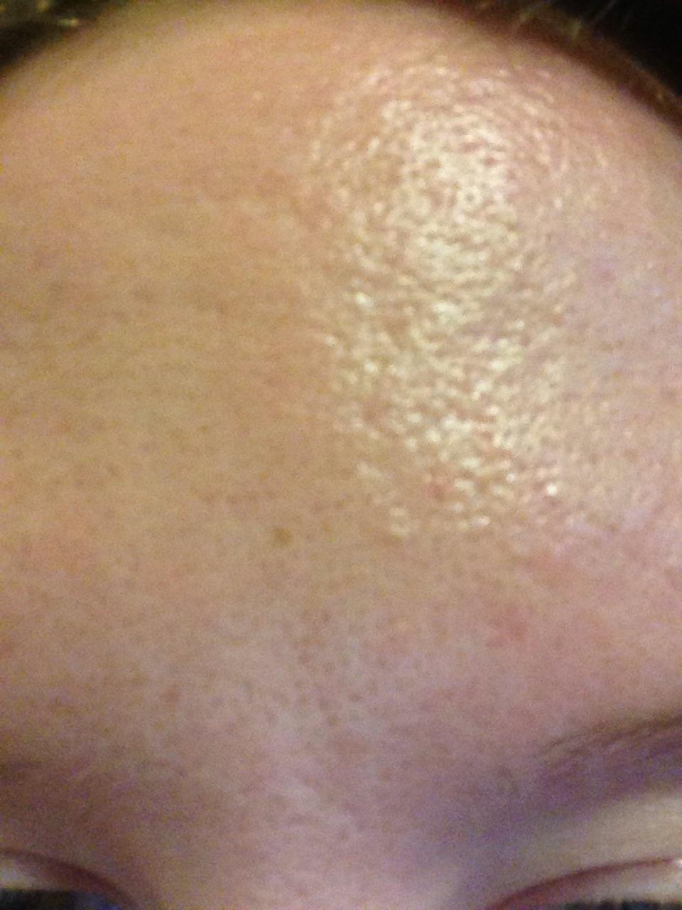 Is there any treatment for my skin texture and scaring? - Scar