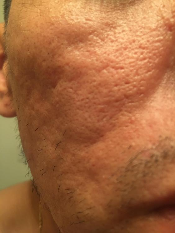 HELP! Please severe acne scars - Hypertrophic (raised) scars - Acne.org