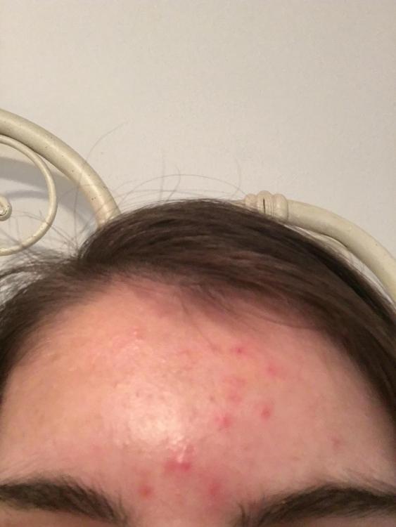 zits on forehead